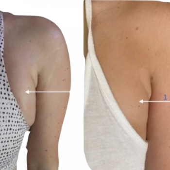 arm chest reduction